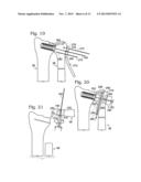 PARTIAL OR COMPLETE PROSTHETIC REPLACEMENT ARTHROPLASTY OF THE DISTAL     RADIOULNAR JOINT diagram and image