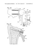 PARTIAL OR COMPLETE PROSTHETIC REPLACEMENT ARTHROPLASTY OF THE DISTAL     RADIOULNAR JOINT diagram and image