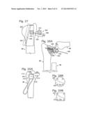 PARTIAL OR COMPLETE PROSTHETIC REPLACEMENT ARTHROPLASTY OF THE DISTAL     RADIOULNAR JOINT diagram and image