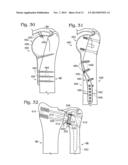 PARTIAL OR COMPLETE PROSTHETIC REPLACEMENT ARTHROPLASTY OF THE DISTAL     RADIOULNAR JOINT diagram and image