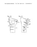 PARTIAL OR COMPLETE PROSTHETIC REPLACEMENT ARTHROPLASTY OF THE DISTAL     RADIOULNAR JOINT diagram and image