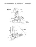 ANKLE REPLACEMENT SYSTEM diagram and image