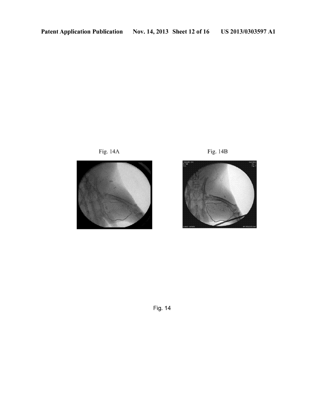 SDF-1 DELIVERY FOR TREATING ISCHEMIC TISSUE - diagram, schematic, and image 13