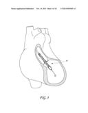 SHEATH SYSTEM FOR CATHETER PUMP diagram and image