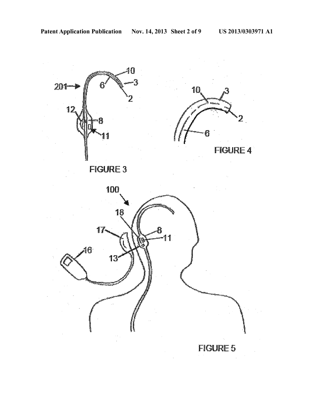 CATHETER AND SHUNT SYSTEM INCLUDING THE CATHETER - diagram, schematic, and image 03