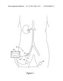 RENAL NERVE MODULATION DEVICES diagram and image