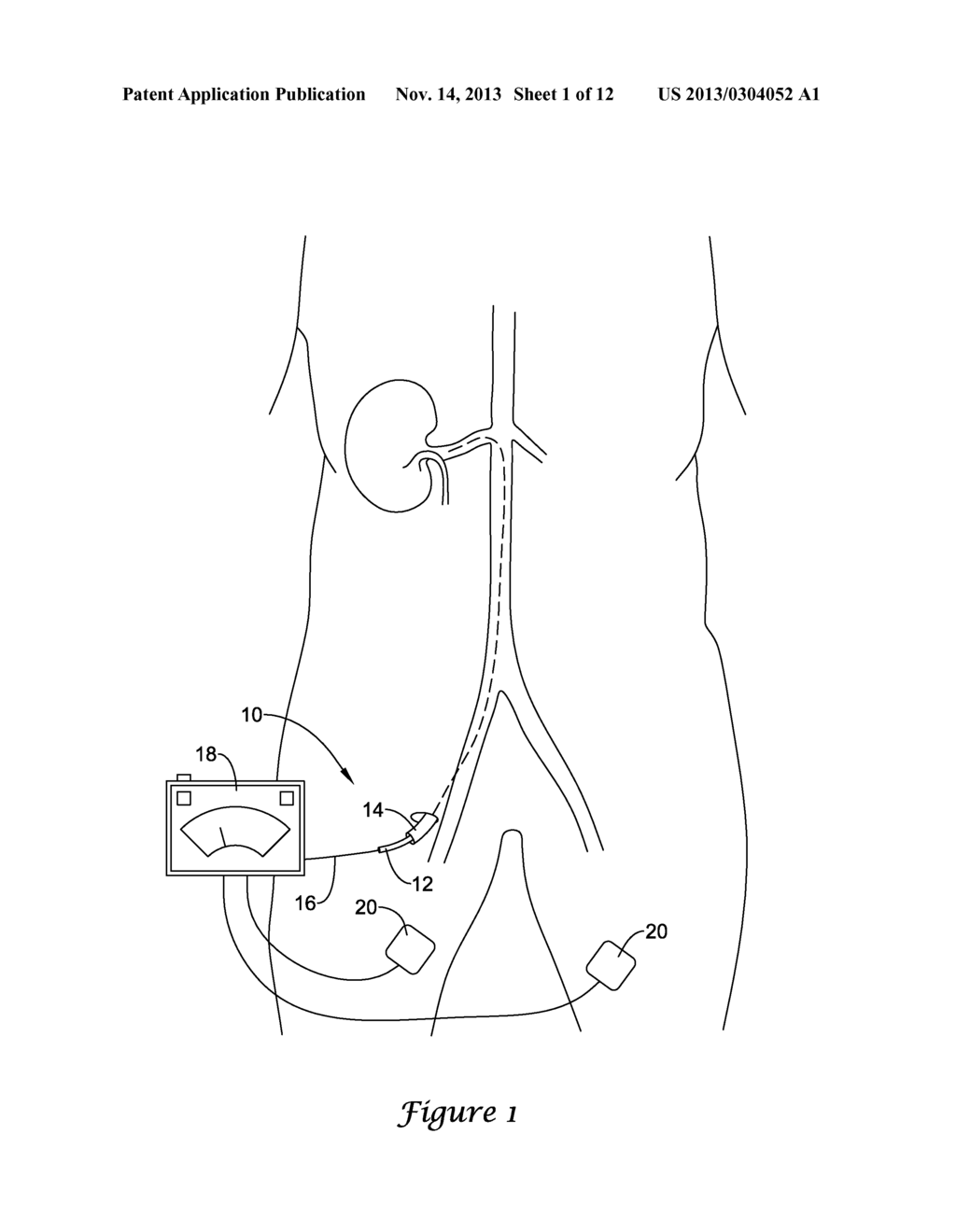 RENAL NERVE MODULATION DEVICES - diagram, schematic, and image 02