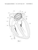 ENHANCED MEDICAL DEVICE FOR USE IN BODILY CAVITIES, FOR EXAMPLE AN ATRIUM diagram and image