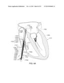 ENHANCED MEDICAL DEVICE FOR USE IN BODILY CAVITIES, FOR EXAMPLE AN ATRIUM diagram and image