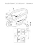 ENHANCED MEDICAL DEVICE FOR USE IN BODILY CAVITIES, FOR EXAMPLE AN ATRIUM diagram and image