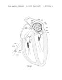 ENHANCED MEDICAL DEVICE FOR USE IN BODILY CAVITIES, FOR EXAMPLE AN ATRIUM diagram and image