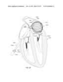 ENHANCED MEDICAL DEVICE FOR USE IN BODILY CAVITIES, FOR EXAMPLE AN ATRIUM diagram and image