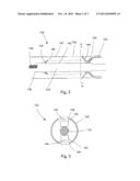 BUSHING ARM DEFORMATION MECHANISM diagram and image