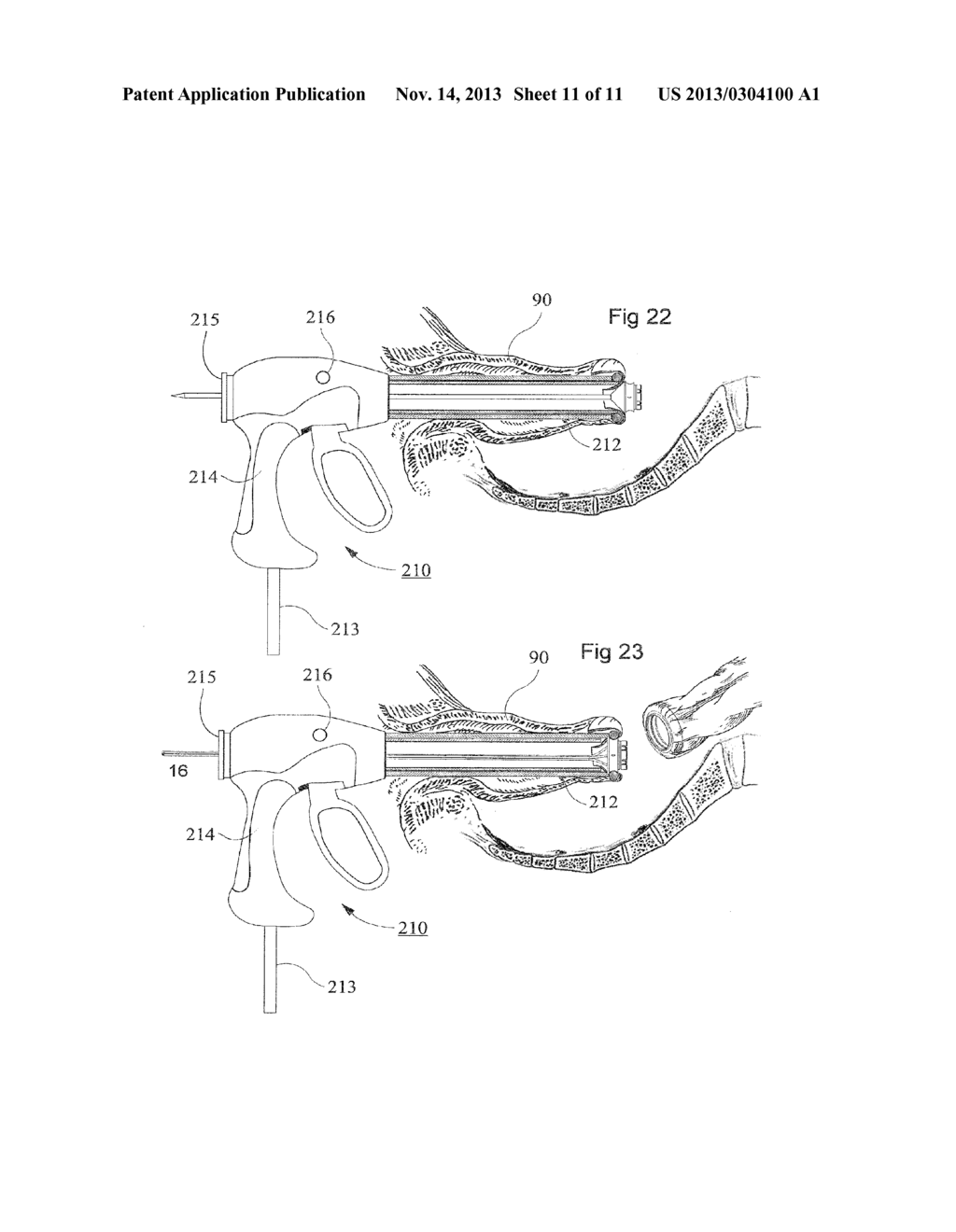 DEVICE AND METHOD FOR ANASTOMOSIS - diagram, schematic, and image 12