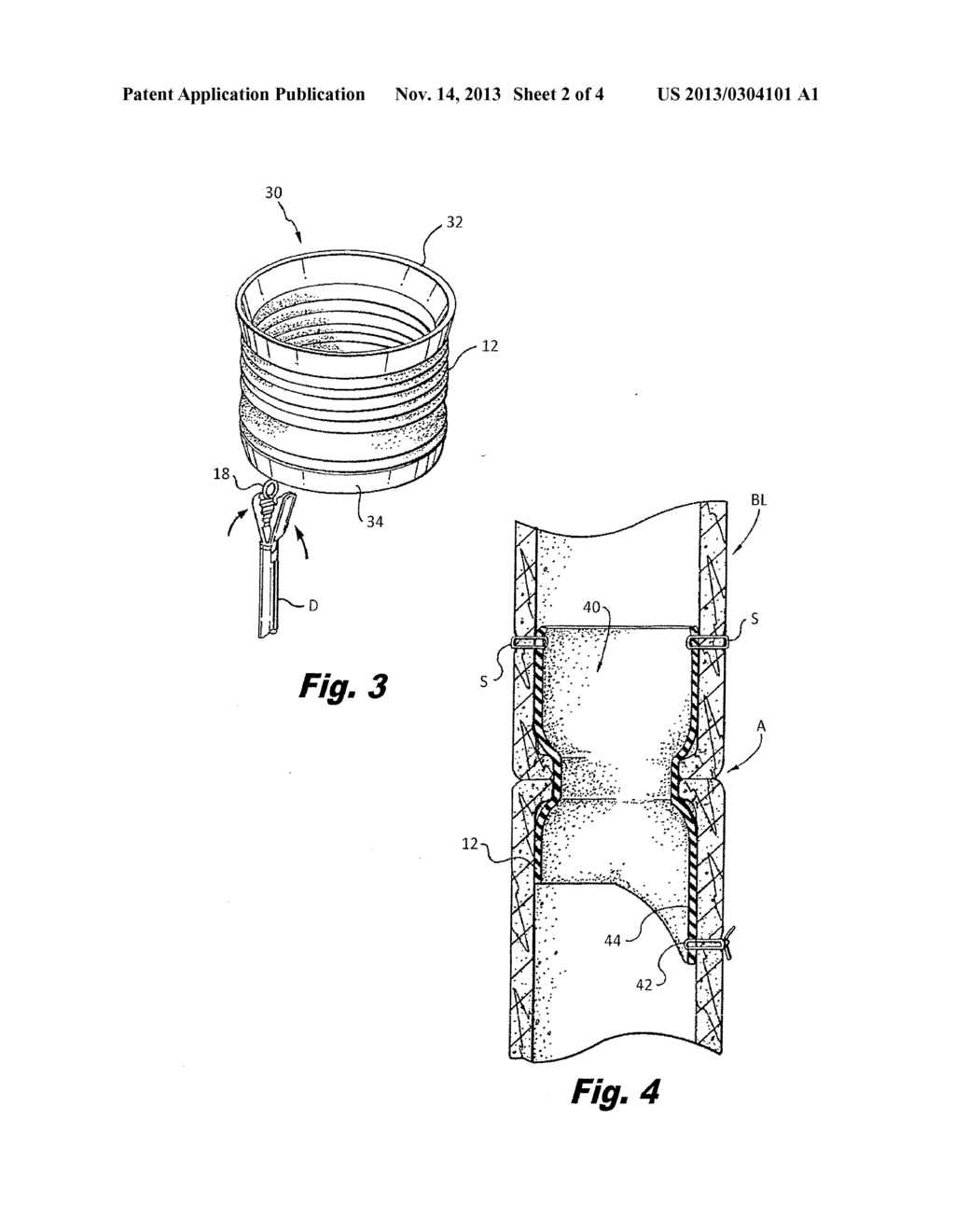 ANASTOMOSIS SHEATH AND METHOD OF USE - diagram, schematic, and image 03