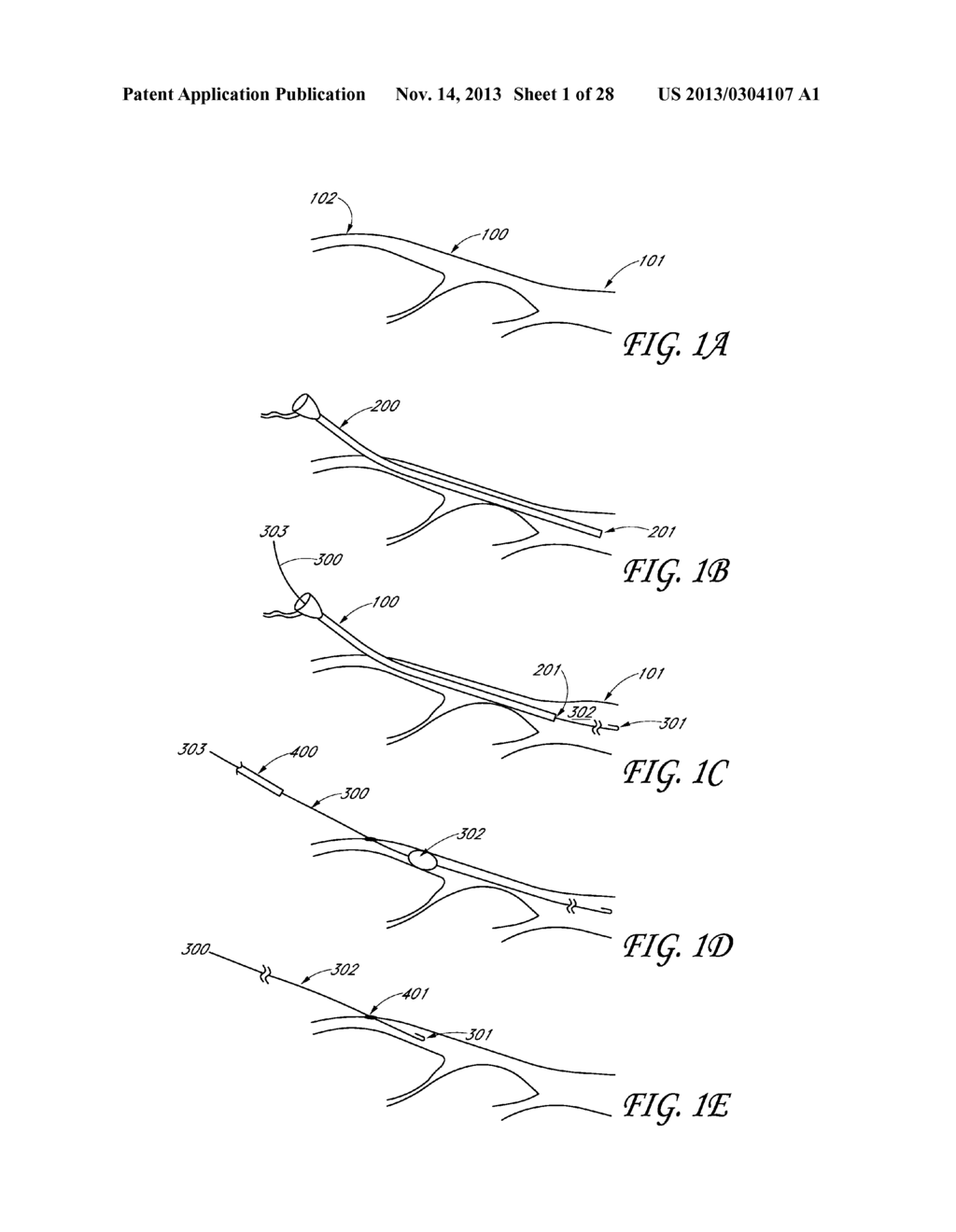 METHOD AND DEVICES FOR FLOW OCCLUSION DURING DEVICE EXCHANGES - diagram, schematic, and image 02