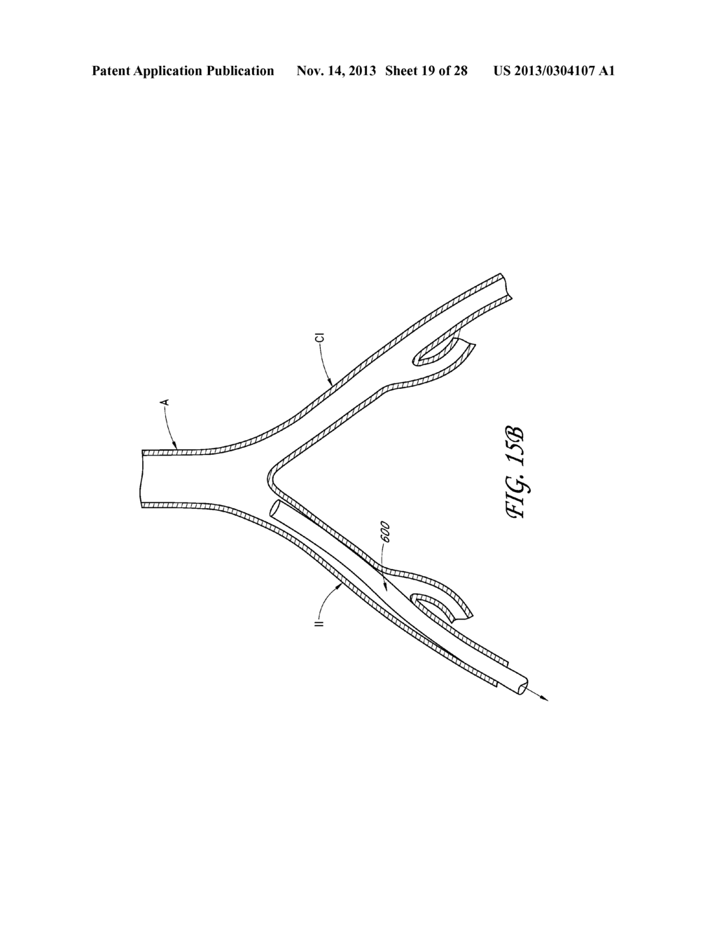 METHOD AND DEVICES FOR FLOW OCCLUSION DURING DEVICE EXCHANGES - diagram, schematic, and image 20