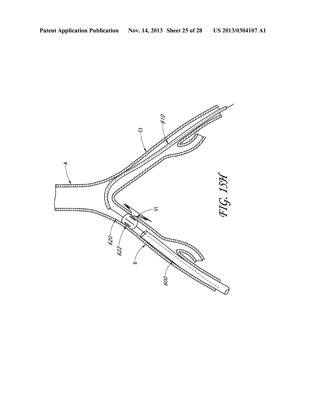 METHOD AND DEVICES FOR FLOW OCCLUSION DURING DEVICE EXCHANGES - diagram, schematic, and image 26