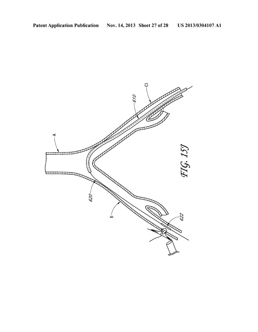 METHOD AND DEVICES FOR FLOW OCCLUSION DURING DEVICE EXCHANGES - diagram, schematic, and image 28