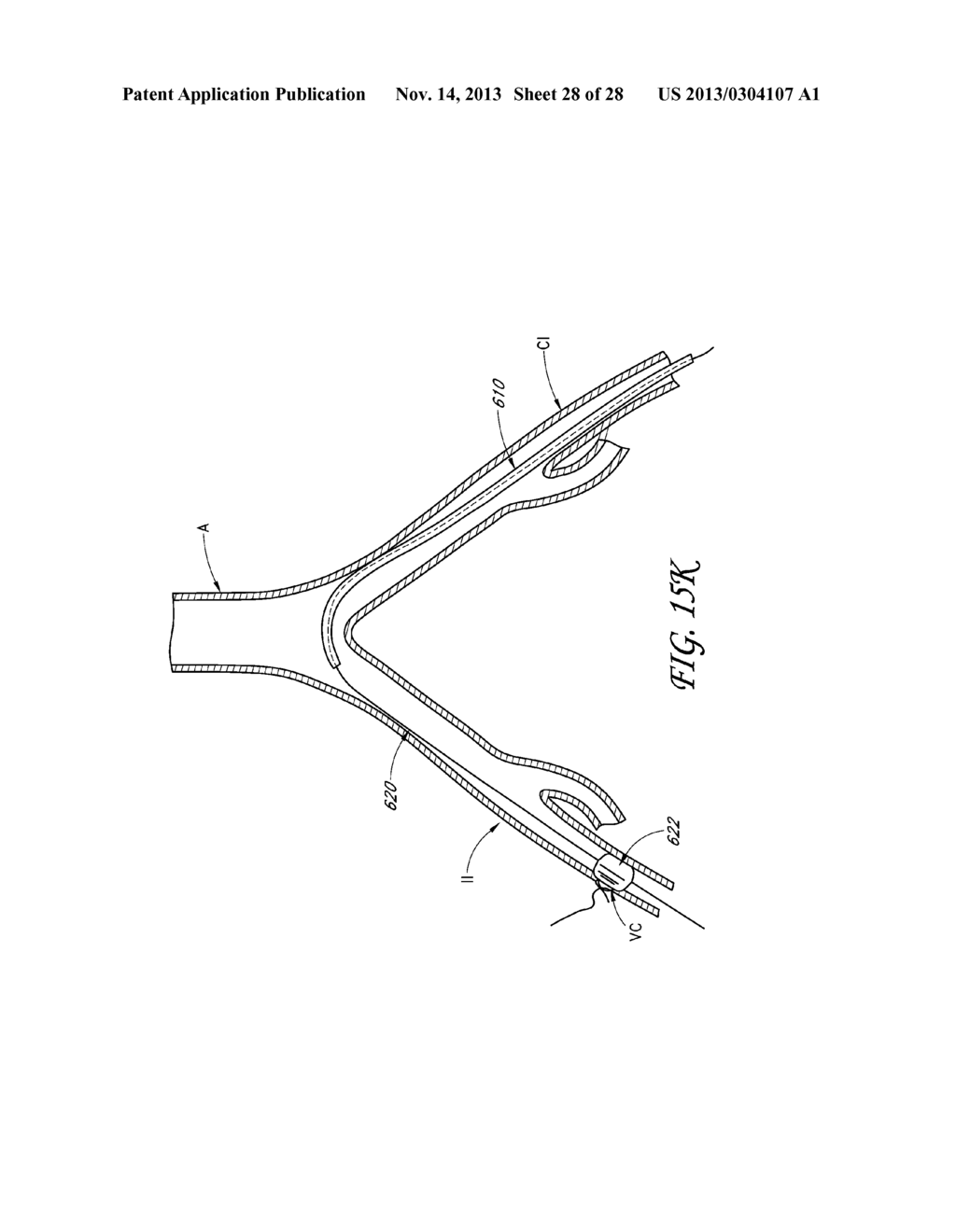 METHOD AND DEVICES FOR FLOW OCCLUSION DURING DEVICE EXCHANGES - diagram, schematic, and image 29