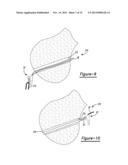 Method And Apparatus For Soft Tissue Attachment diagram and image