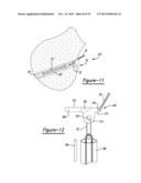 Method And Apparatus For Soft Tissue Attachment diagram and image