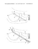 Method And Apparatus For Soft Tissue Attachment diagram and image