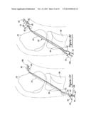 Method And Apparatus For Soft Tissue Attachment diagram and image