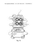 SYSTEM AND METHOD FOR VERTEBRAL BODY PLATING diagram and image