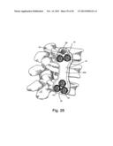 SYSTEM AND METHOD FOR VERTEBRAL BODY PLATING diagram and image