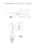 PERIPHERAL NERVE INTERFACE DEVICES FOR TREATMENT AND PREVENTION OF     NEUROMAS diagram and image