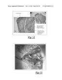 PERIPHERAL NERVE INTERFACE DEVICES FOR TREATMENT AND PREVENTION OF     NEUROMAS diagram and image