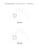 Device and Method for Self-Positioning of a Stimulation Device to Activate     Brown Adipose Tissue Depot in a Supraclavicular Fossa Region diagram and image