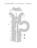 METHODS AND APPARATUS FOR LUMINAL STENTING diagram and image