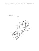 STENT GRAFT diagram and image