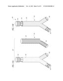 STENT GRAFT diagram and image