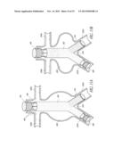 STENT GRAFT diagram and image