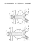 STENT GRAFT diagram and image