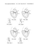 PROSTHETIC HEART VALVE DEVICES, PROSTHETIC MITRAL VALVES AND ASSOCIATED     SYSTEMS AND METHODS diagram and image