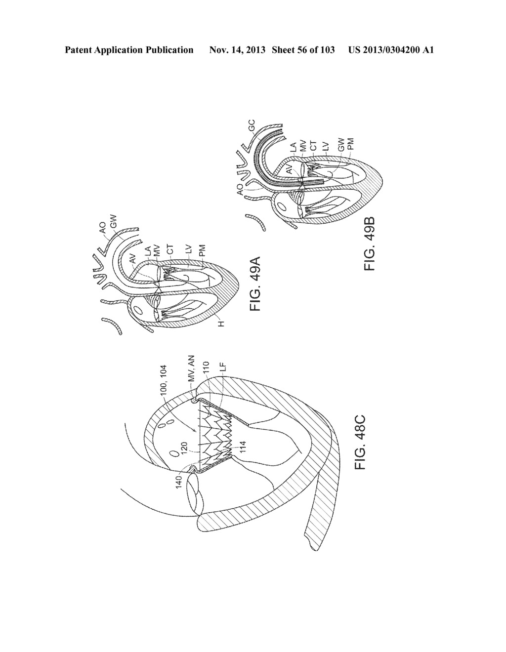PROSTHETIC HEART VALVE DEVICES, PROSTHETIC MITRAL VALVES AND ASSOCIATED     SYSTEMS AND METHODS - diagram, schematic, and image 57
