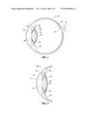 Accommodating Intraocular Lenses diagram and image