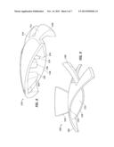 Accommodating Intraocular Lenses diagram and image