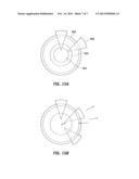 Accommodating Intraocular Lenses diagram and image