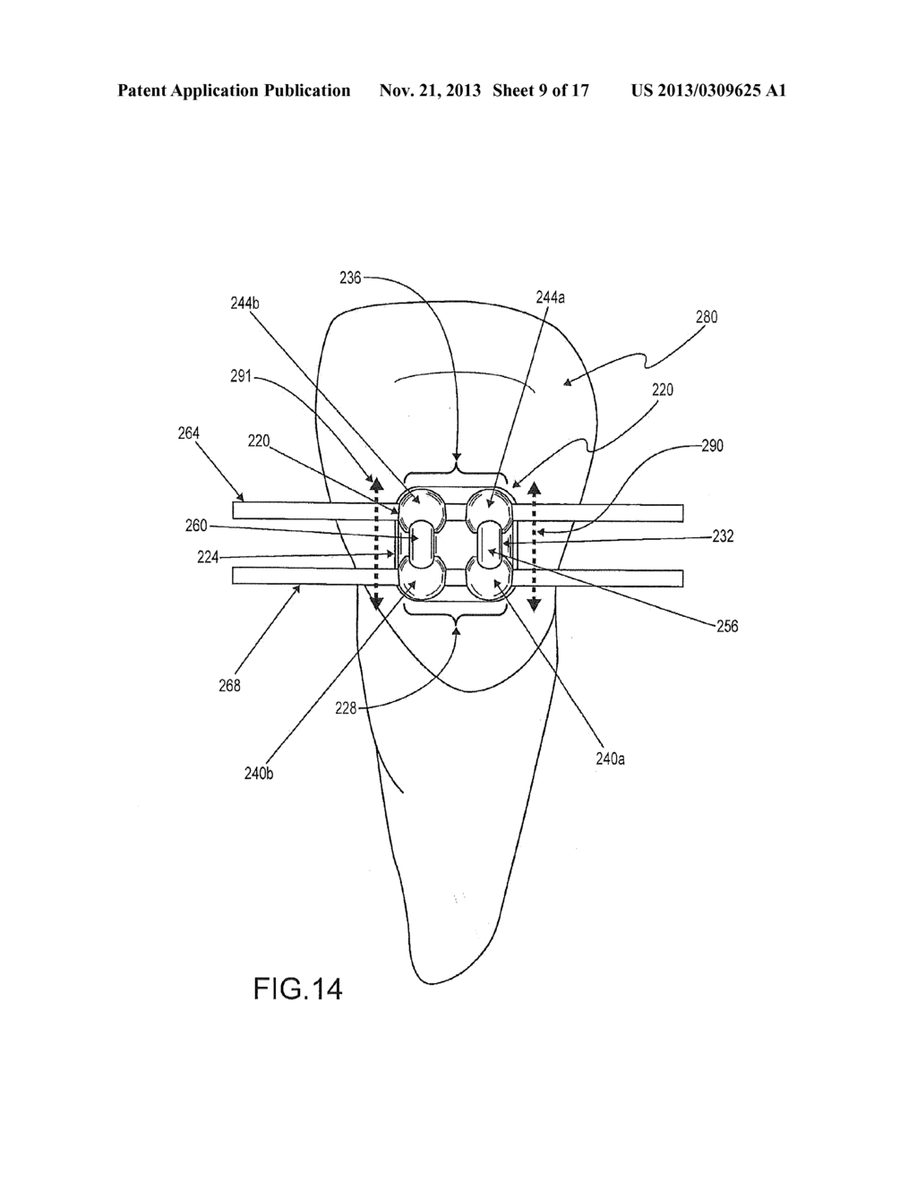 Orthodontic Bracket System Having an Archwire Channel and Archwire     Retaining Mechanism - diagram, schematic, and image 10