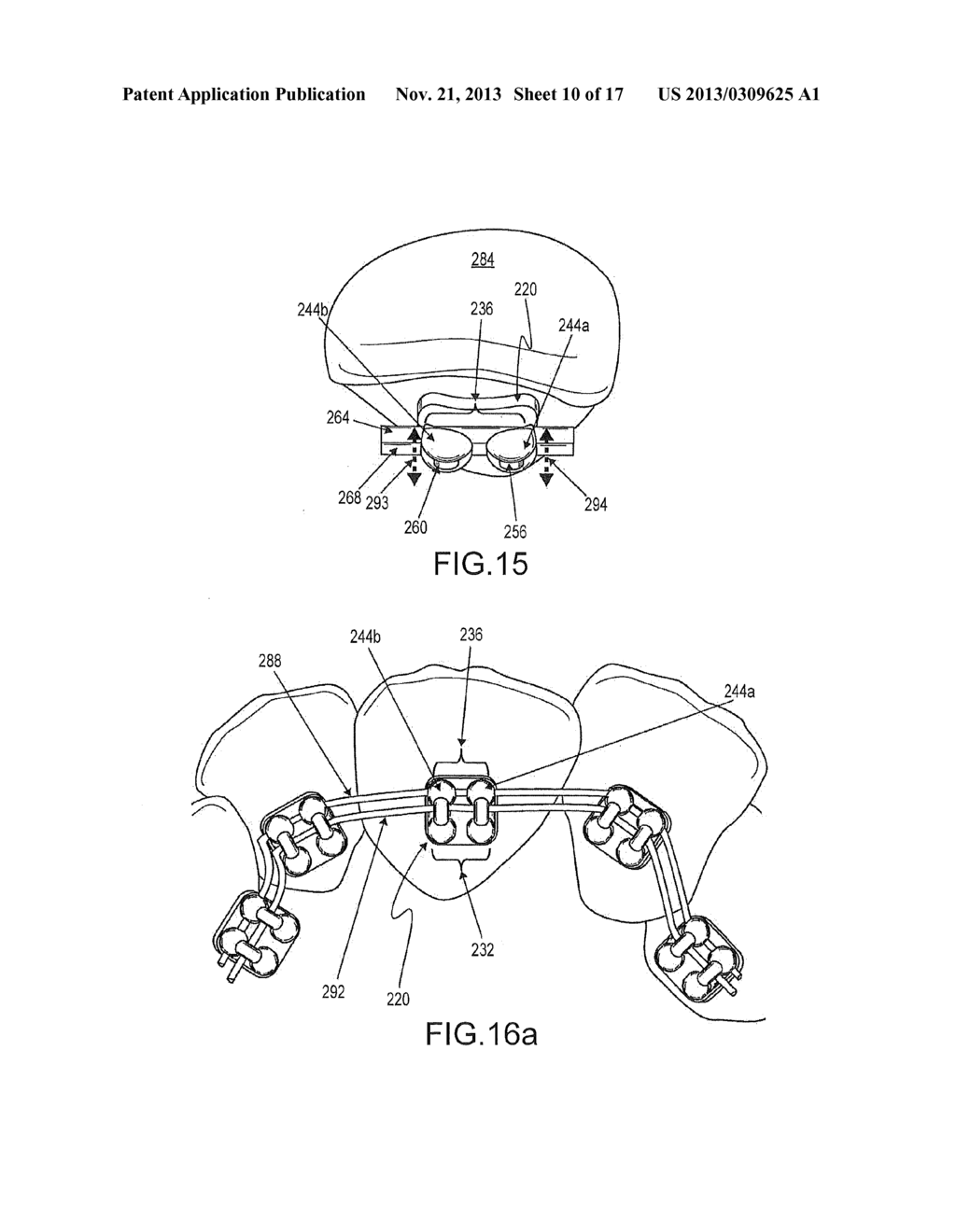 Orthodontic Bracket System Having an Archwire Channel and Archwire     Retaining Mechanism - diagram, schematic, and image 11