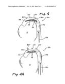 INTRA-AORTIC BALLOON COUNTERPULSATION WITH CONCURRENT HYPOTHERMIA diagram and image