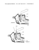 LARYNGOSCOPY diagram and image