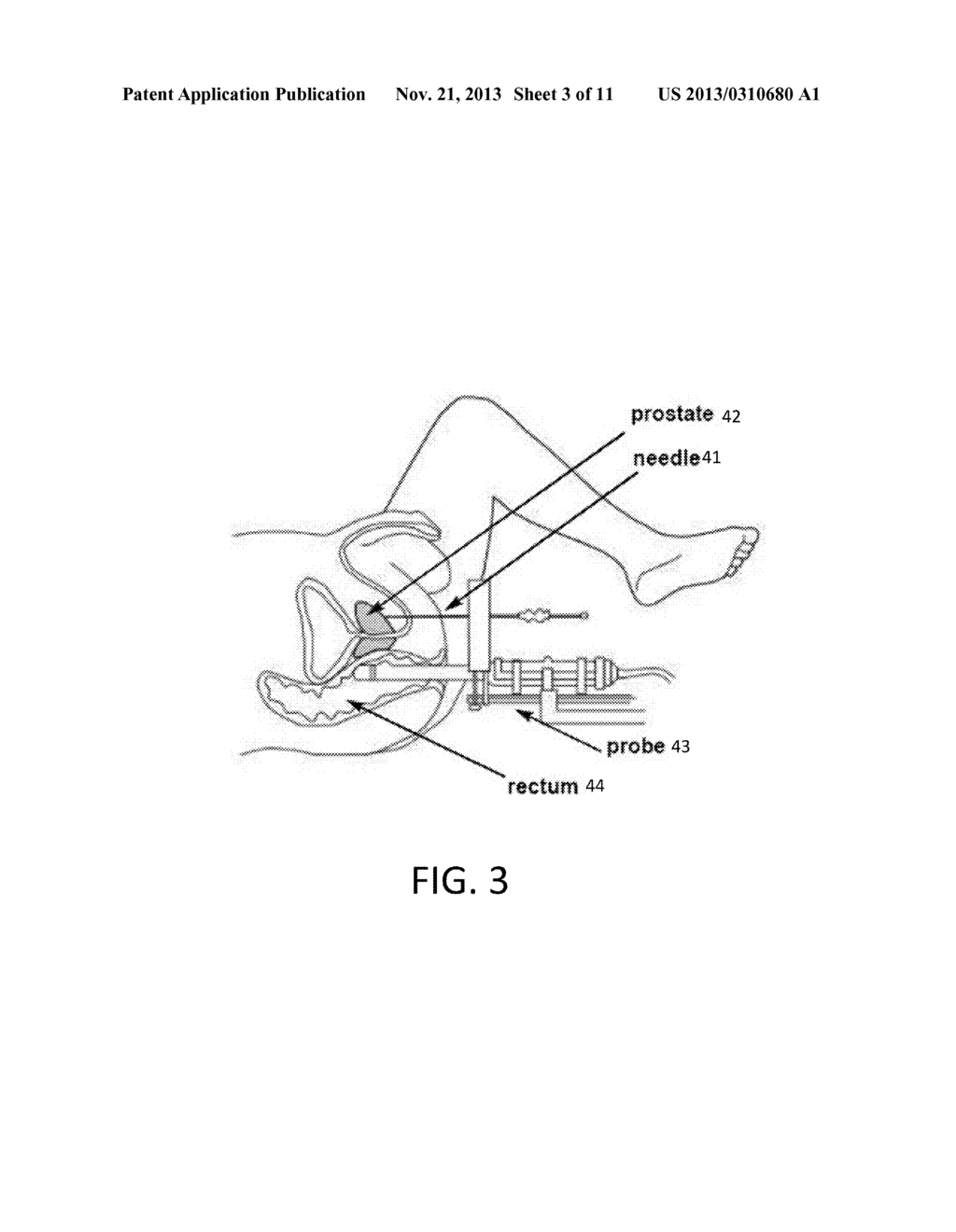 THREE-DIMENSIONAL OPTICAL IMAGING AND THERAPY OF PROSTATE CANCER - diagram, schematic, and image 04