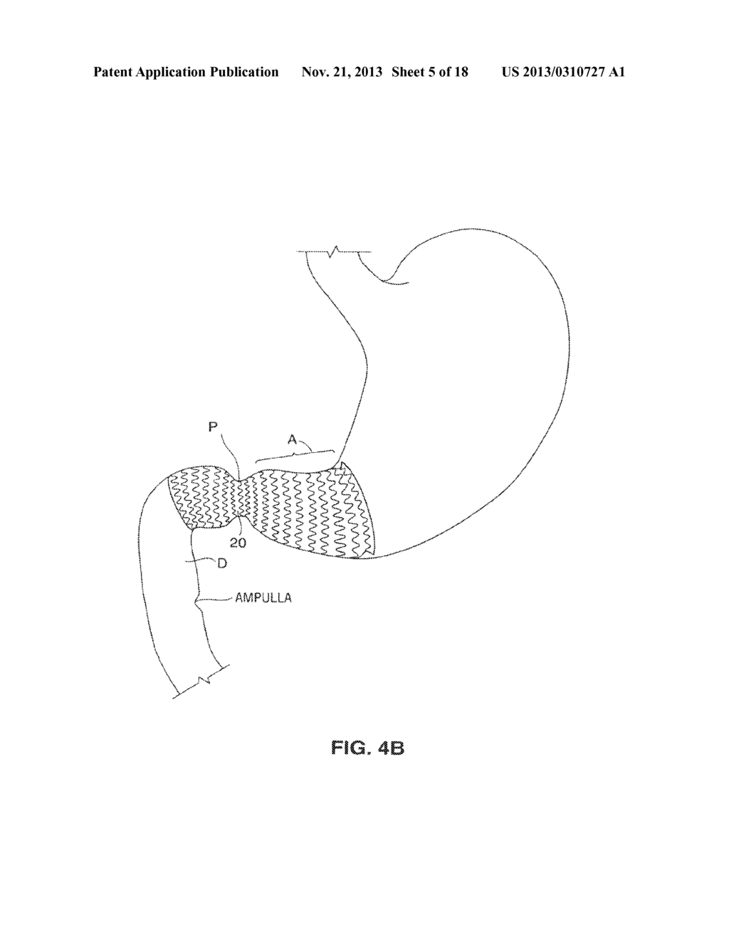 SATIATION DEVICES AND METHODS - diagram, schematic, and image 06