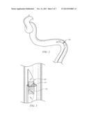 Clot Removal Device and Method of Using Same diagram and image